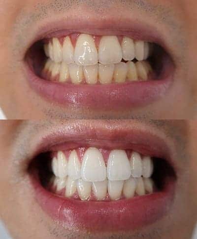 Teeth before and after whitening